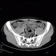 CT enterography, low-dose: CT - Computed tomography