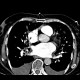 Lung congestion, interstitial edema: CT - Computed tomography