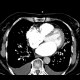 Lung congestion, interstitial edema: CT - Computed tomography