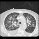 Lung congestion, interstitial edema: CT - Computed tomography