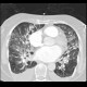 Lung congestion, interstitial edema: CT - Computed tomography