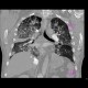 Lung contusion: CT - Computed tomography