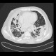 Lung tuberculosis, caseous pneumonia, HRCT: CT - Computed tomography