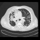 Lung tuberculosis, caseous pneumonia, HRCT: CT - Computed tomography