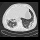 Lung tuberculosis, caseous pneumonia, HRCT: CT - Computed tomography