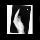 Dislocation of interphalangeal joint of thumb: X-ray - Plain radiograph