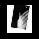 Dislocation of interphalangeal joint of thumb: X-ray - Plain radiograph