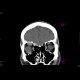 Lymphoma of the orbit: CT - Computed tomography