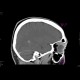 Lymphoma of the orbit: CT - Computed tomography