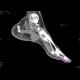 Plantar lymphoma: CT - Computed tomography