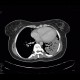 Lymphoma of the lung and spleen: CT - Computed tomography