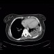 Lymphoma of the lung and spleen: CT - Computed tomography