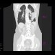 Lymphoma of the lung and spleen: CT - Computed tomography