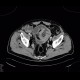 Lymphoma of small bowel, ileum: CT - Computed tomography