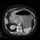 Lymphoma of stomach: CT - Computed tomography