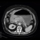 Lymphoma of stomach: CT - Computed tomography