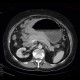 Lymphoma of stomach: CT - Computed tomography