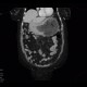 Lymphoma of stomach: CT - Computed tomography