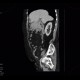 Lymphoma of stomach: CT - Computed tomography