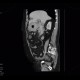 Lymphoma of stomach: CT - Computed tomography