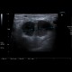Lymph node in lymphoma: US - Ultrasound