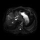 Liver metastasis of adenocarcinoma of colon, colorectal carcinoma, biopsy: MRI - Magnetic Resonance Imaging