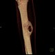 Metastasis of melanoma in the tibia: CT - Computed tomography
