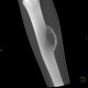 Metastasis of melanoma in the tibia: CT - Computed tomography