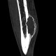 Metastasis of melanoma in the tibia: CT - Computed tomography