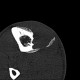 Metastasis of melanoma in the tibia: CT - Computed tomography