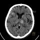 Metastatic disease of the brain: CT - Computed tomography