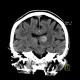 Metastatic disease of the brain: CT - Computed tomography