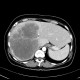 Metastasis of tubular carcinoma of large bowel, colorectal carcinoma, hemihepatectomy: CT - Computed tomography