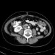 Metastasis of tubular carcinoma of large bowel, colorectal carcinoma, hemihepatectomy: CT - Computed tomography