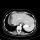 Metastasis of tubular carcinoma of large bowel, colorectal carcinoma, hemihepatectomy: CT - Computed tomography