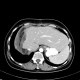 Metastasis of tubular carcinoma of large bowel, colorectal carcinoma, hemihepatectomy: CT - Computed tomography