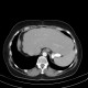 Metastasis of tubular carcinoma of large bowel, colorectal carcinoma, hemihepatectomy: CT - Computed tomography