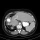 Metastasis of tubular carcinoma of large bowel, colorectal carcinoma, hemihepatectomy: CT - Computed tomography