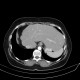 Metastasis of tubular carcinoma of large bowel, colorectal carcinoma, hemihepatectomy: CT - Computed tomography
