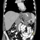 Metastases of malignant melanoma, liver, stomach, adrenal gland, retroperitoneal lymph nodes: CT - Computed tomography