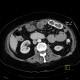 Migration of stent, ileus: CT - Computed tomography
