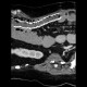 Migration of stent, ileus: CT - Computed tomography