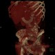 Migration of stent, ileus: CT - Computed tomography