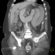Migration of stent, ileus: CT - Computed tomography