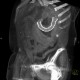 Migration of stent, ileus: CT - Computed tomography