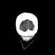 Subdural hemorrhage, minute: CT - Computed tomography