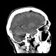 Subdural hemorrhage, minute: CT - Computed tomography
