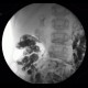 MNGIE, Mitochondrial neurogastrointestinal encephalopathy: RF - Fluoroscopy