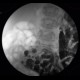 MNGIE, Mitochondrial neurogastrointestinal encephalopathy: RF - Fluoroscopy