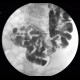 MNGIE, Mitochondrial neurogastrointestinal encephalopathy: RF - Fluoroscopy